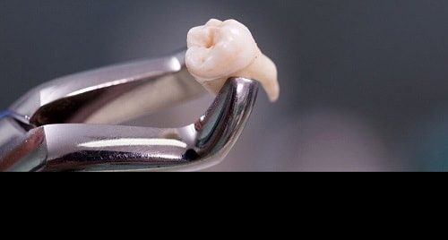 یکساعت فرصت برای کاشت دوباره دندان