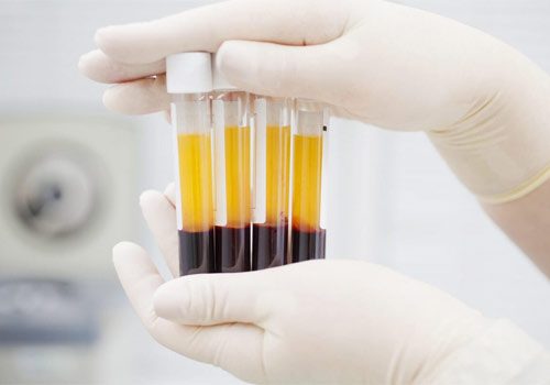 ارائه روش تزریق پلاسمای خون بهبود یافتگان به مبتلایان کرونا