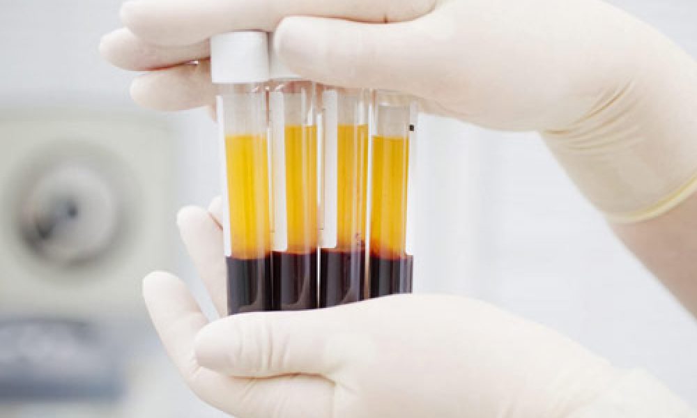 ارائه روش تزریق پلاسمای خون بهبود یافتگان به مبتلایان کرونا