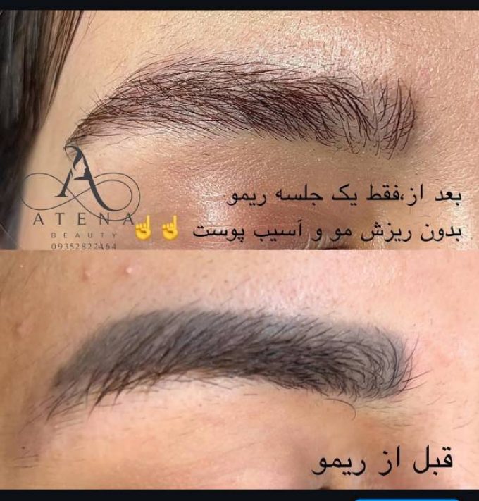 ریموو تتو در سمنان