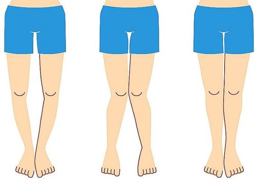 حرکات اصلاحی درمان زانو ضربدری