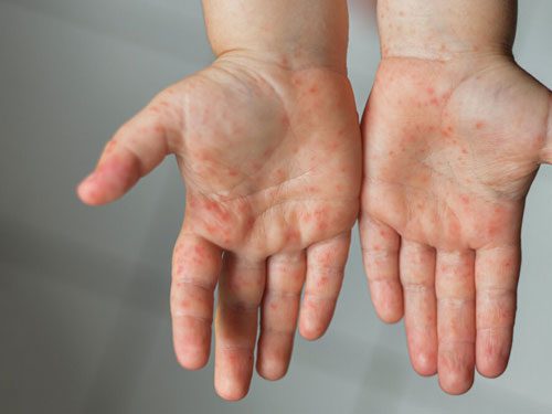 مراجع ۲۴ فرد مشکوک به بیماری سرخک به مراکز درمانی