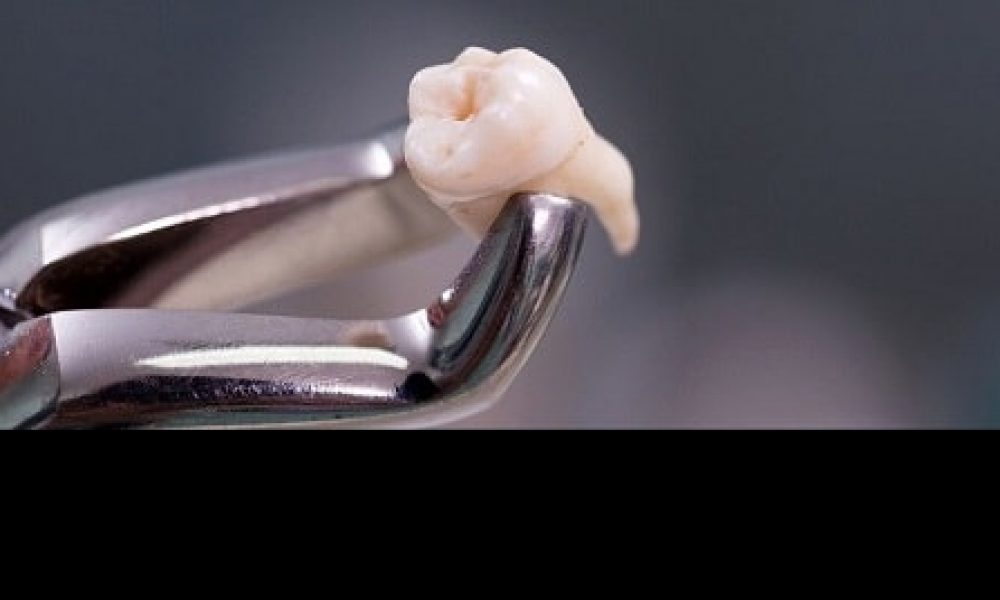 یکساعت فرصت برای کاشت دوباره دندان